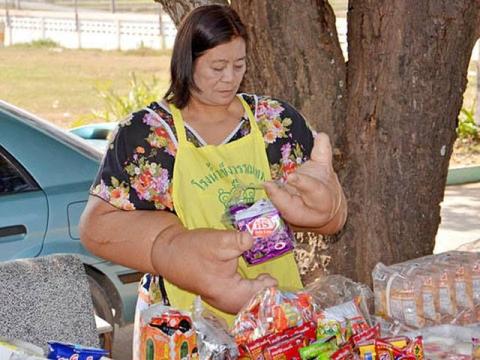 Женщина с руками весом в 100 кг отказывается от ампутации