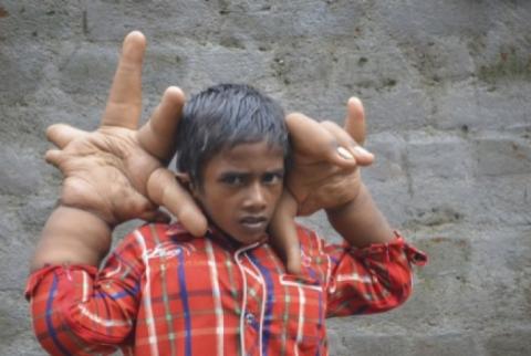 Врачи уменьшили индийскому мальчику гигантскую руку