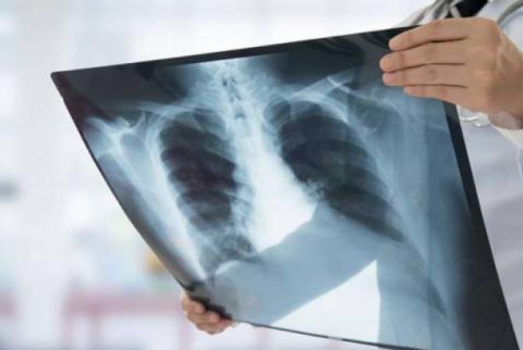 Hospitalized Chinese tourist in Armenia tests negative for pneumonia, to remain under monitoring 