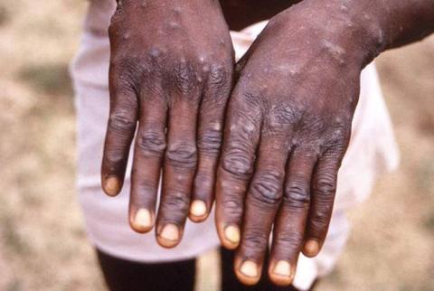 World Health Network declares monkeypox a pandemic