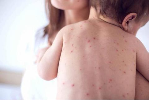 Healthcare ministry reports 12 confirmed cases of measles 