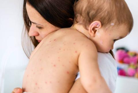 9 new cases of measles confirmed in last 24 hours 