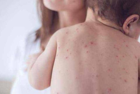 Healthcare Ministry reports new cases of measles, two patients in serious condition 