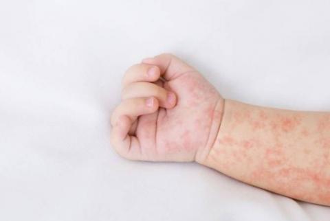 Child dies of measles in Armenia 