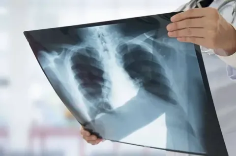 Թոքաբորբով հոսպիտալացվել է 300-ից ավելի բուժառու. թիրախում են երեխաները