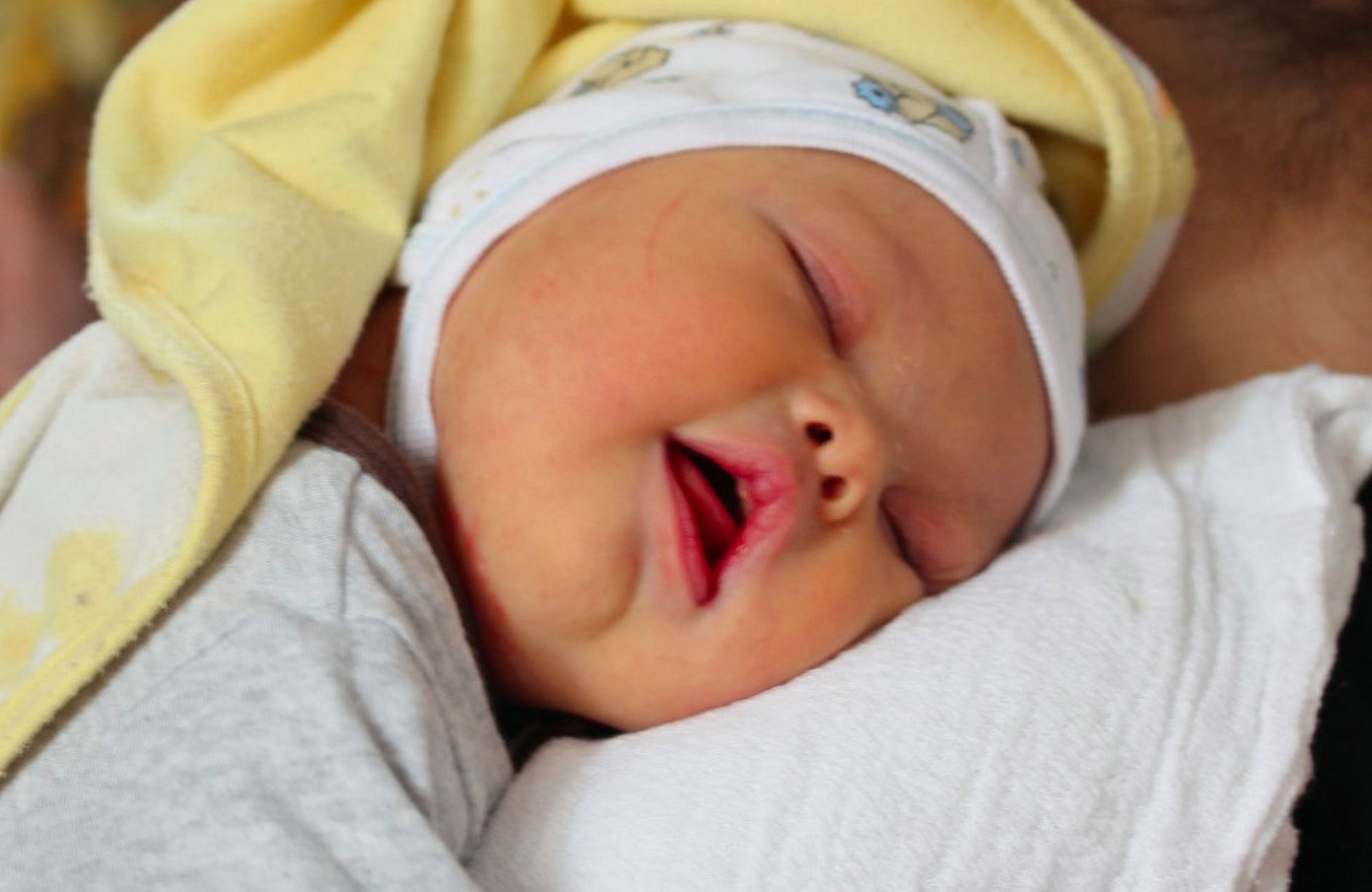 фото новорожденного ребенка с синдромом