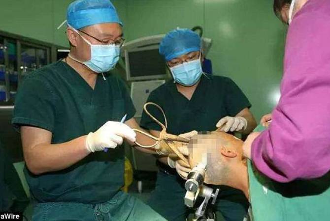 Chinese woman has giant scissors pierced into skull, takes bus to hospital and survives 