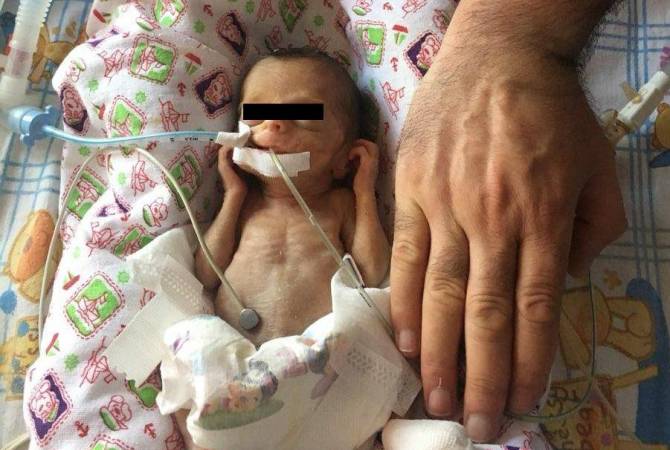  Հայաստանում առաջին անգամ 680 գրամանոց երեխային ենթարկել են սրտի 
վիրահատության