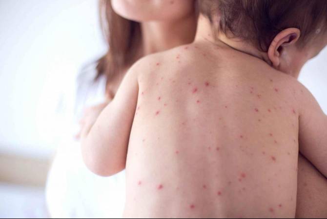 Georgia reports 430 cases of measles 