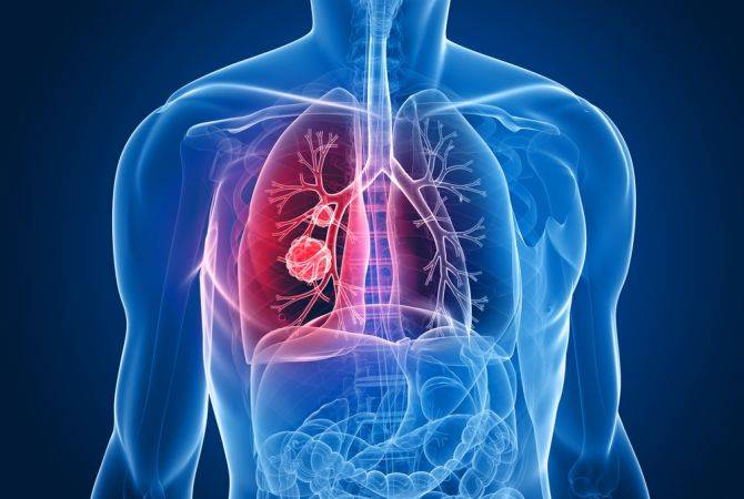 Հայաստանում քաղցկեղի տեսակների մեջ տարածվածությամբ առաջին տեղում թոքի 
քաղցկեղն է