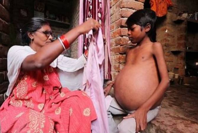 Հանելուկային հիվանդության պատճառով հնդիկ Սուջիթի որովայնը շարունակ մեծանում 
Է
