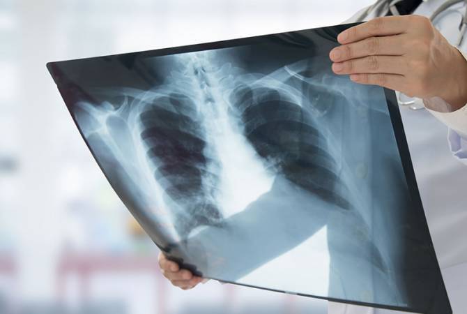 Armenia to obtain more artificial respiration devices